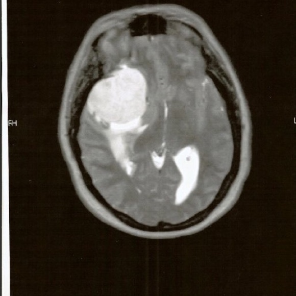 I’m back yall! I’ve added a pink ribbon to my purple one♥️ - Picture 5 of 8